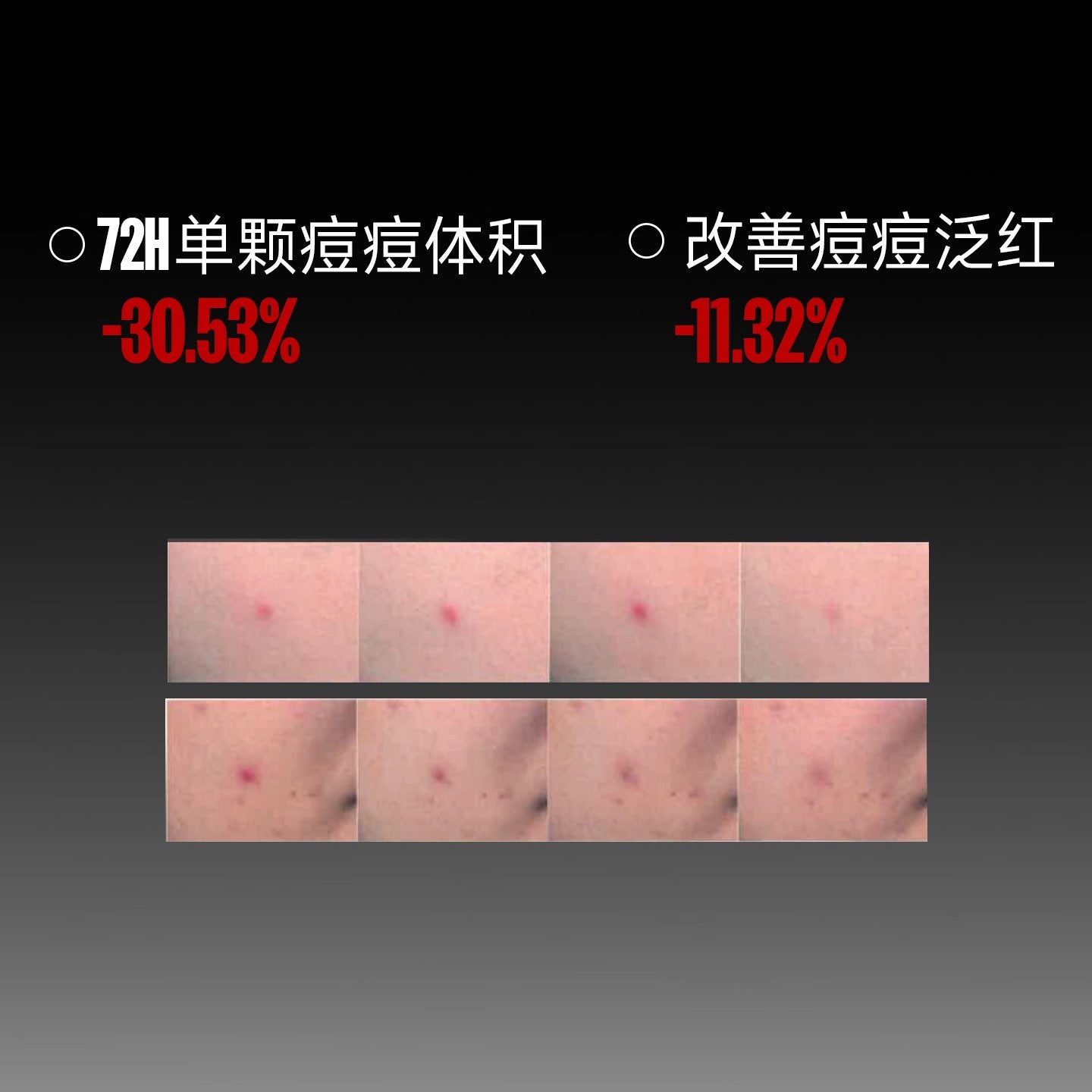 FUFU Acne Patch