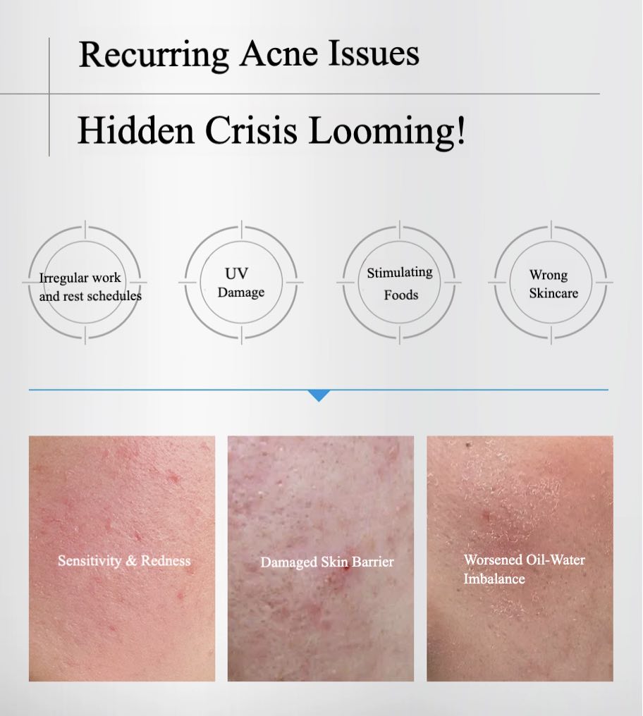 Ful Qun Anti-acne Repair Soothing Mask