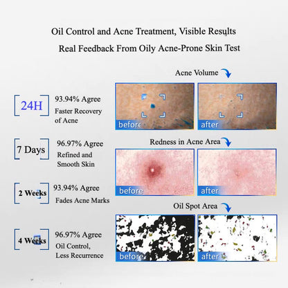 Voolga Acne Cleansing Repair Essence